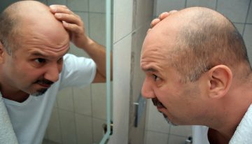 All Your Questions About Scalp Micropigmentation (SMP) Answered